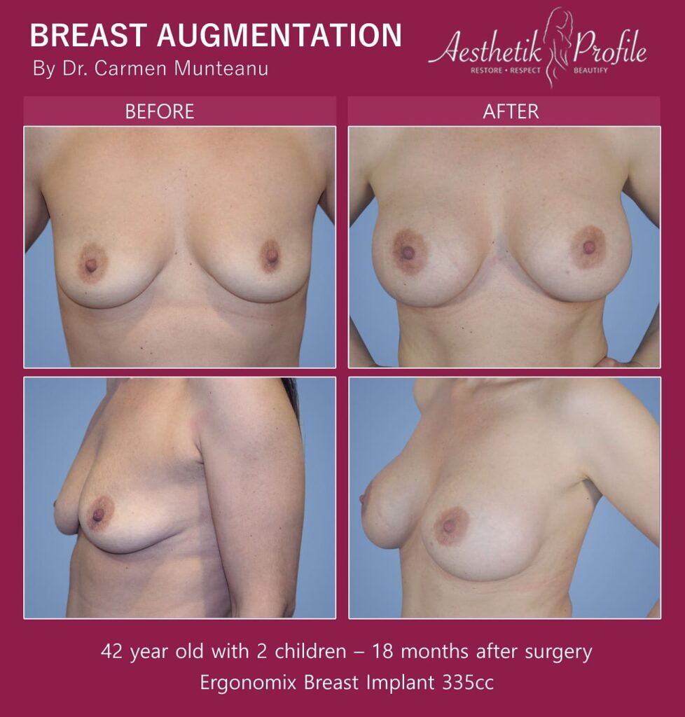 Breast Augmentation Before and After Photos - Boob Job Pics - Dr Carmen Munteanu Melbourne Plastic Surgeon