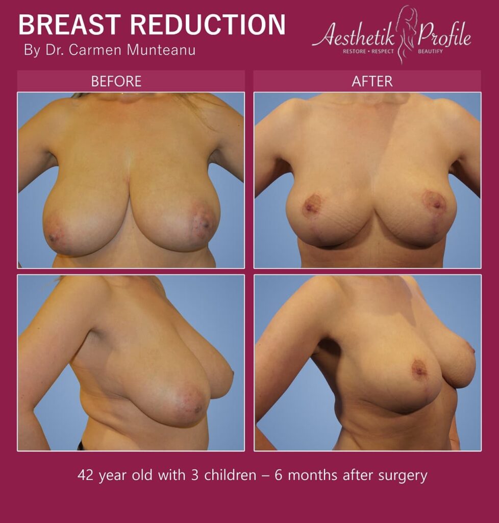 Breast Reduction Before and After Photos - Dr Carmen Munteanu <span class='noncompliant' style='background-color:#ffc0cb;' title='best'>best</span> breast reduction surgeon melbourne